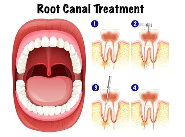 Root Canal Treatment